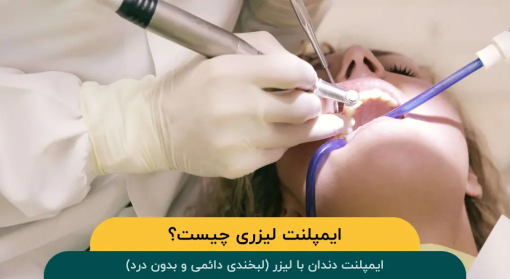 ایمپلنت-دندان-با-لیزر